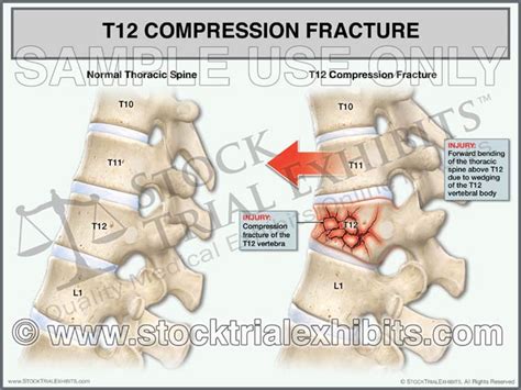 thoracic compression test|brace for thoracic compression fracture.